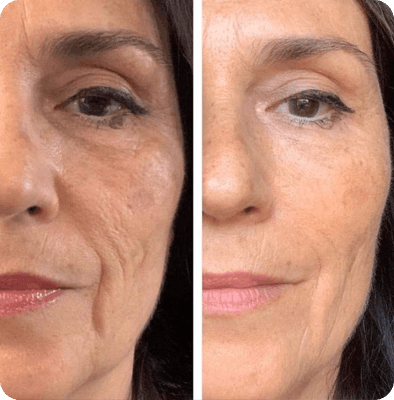 Morpheus8 микроигольчатый RF лицо