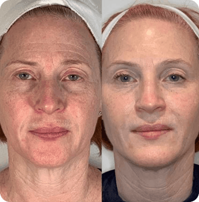 микроигольчатый RF, морфиус8, лицо и шея