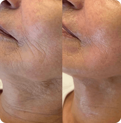 микроигольчатый RF, результаты Гомель