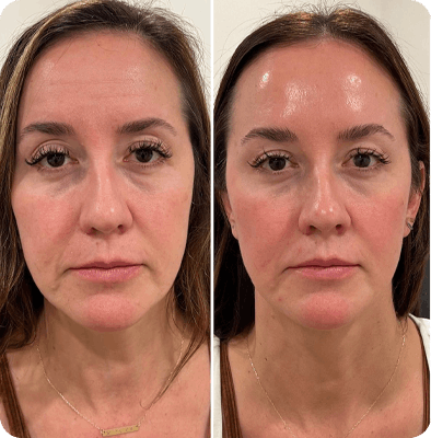 микроигольчатый RF, результаты Гомель