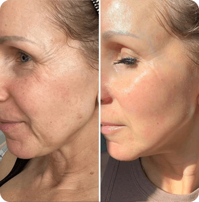 микроигольчатый RF, результаты Гомель