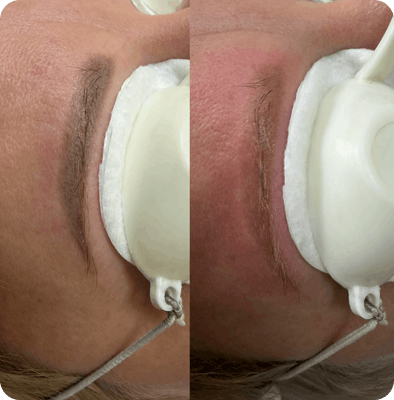 лазерное удаление татуажа и тату