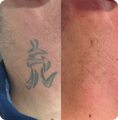 лазерное удаление тату в Гомеле