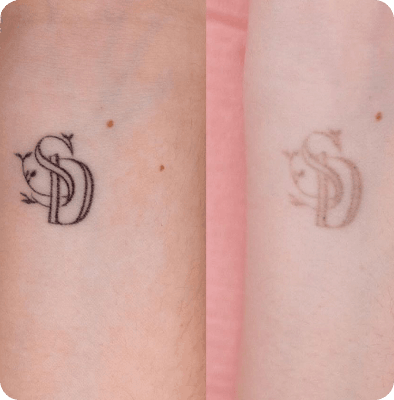  удаление тату Гомель