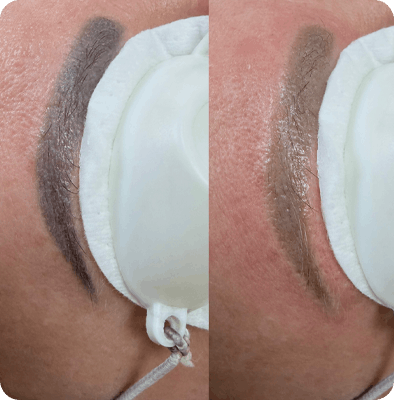 удаление татуировок в Гомеле