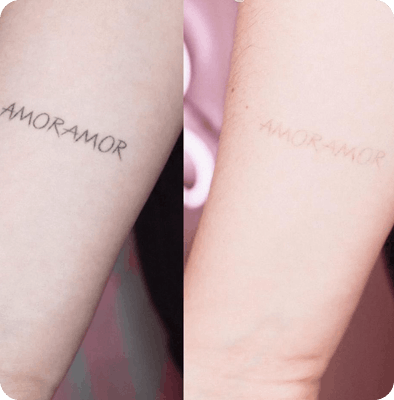 лазерное удаление татуажа в Гомеле