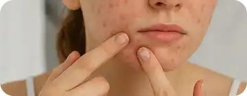 Коррекция пятен после акне