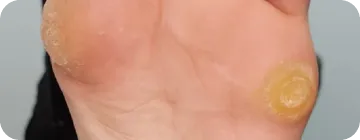удаление натоптышей на ногах