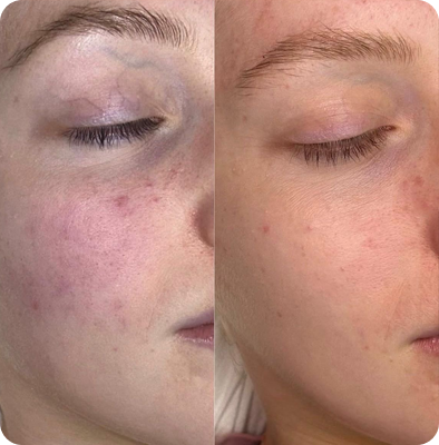 результаты фотолечения Гомель