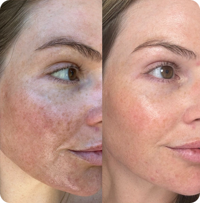 фотолечение