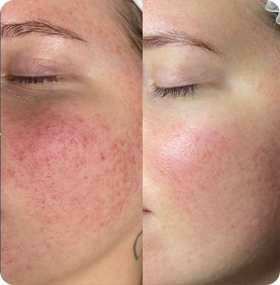 фотоомоложение лица