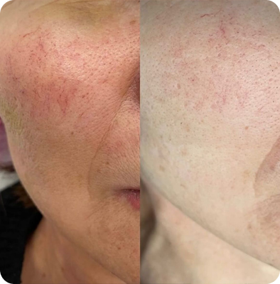 фотоомоложение от морщин